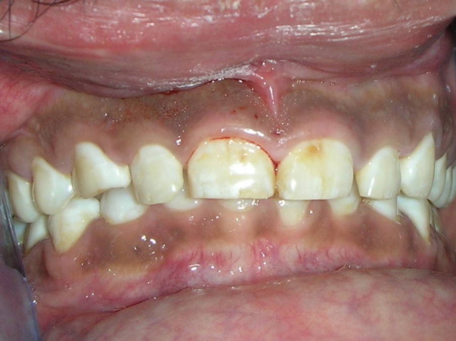 http://dentalexcellence.co.in/wp-content/uploads/2019/11/Pt-1-Pre-5.jpg