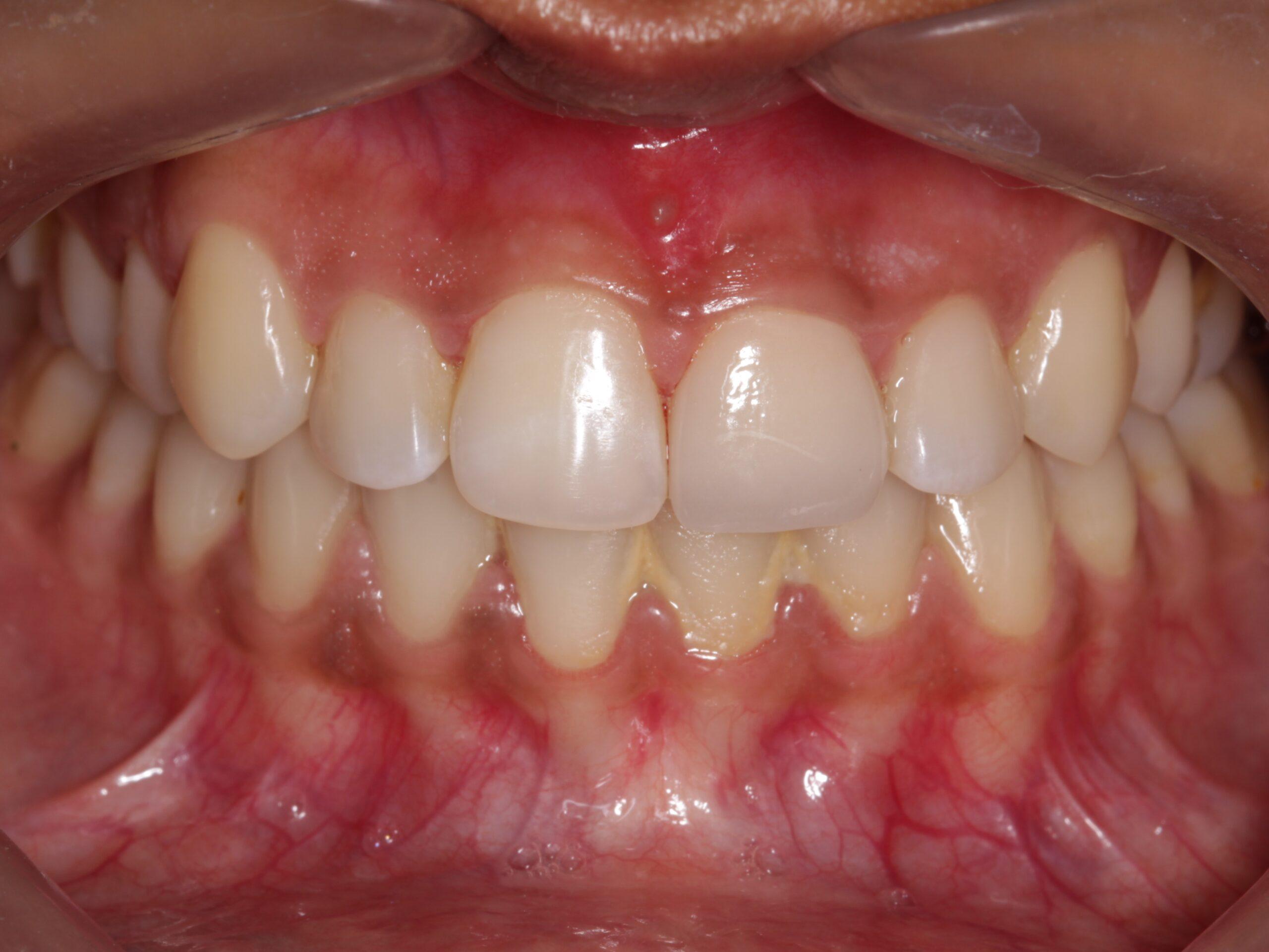 http://dentalexcellence.co.in/wp-content/uploads/2019/11/Pt-2-Post-1-scaled.jpg