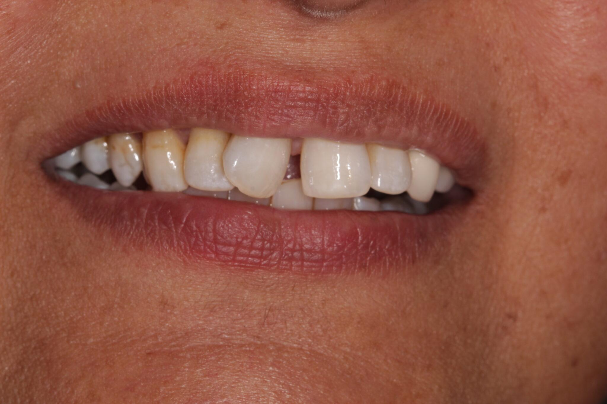 Smile Makeover Veneers Dental Excellence