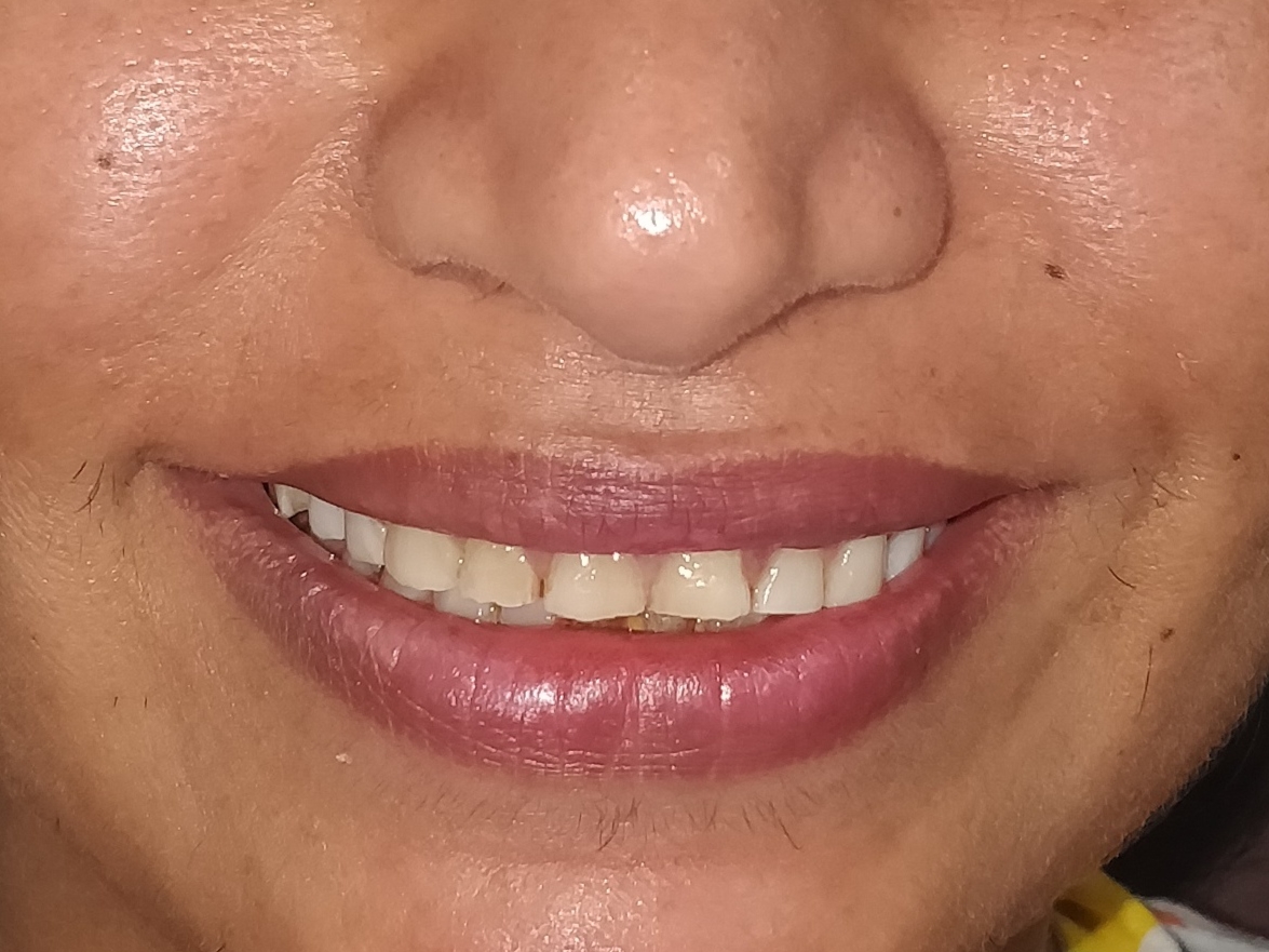http://dentalexcellence.co.in/wp-content/uploads/2019/12/Pt-1-Pre-1.jpg
