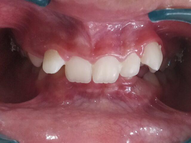 http://dentalexcellence.co.in/wp-content/uploads/2022/04/1-12-640x480.jpg