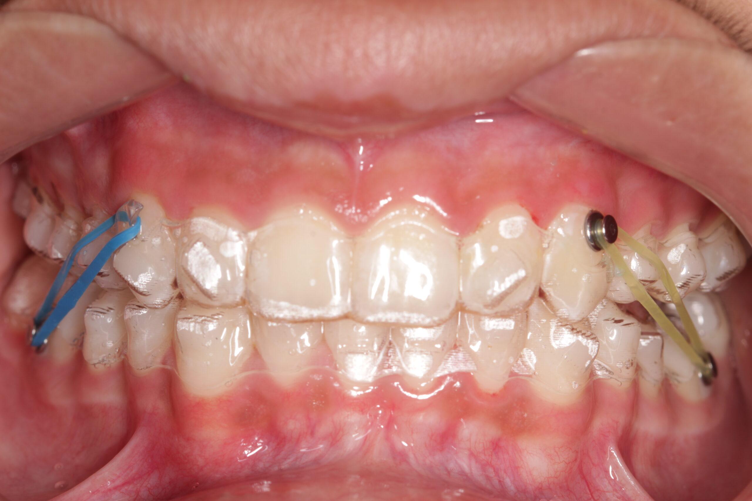 http://dentalexcellence.co.in/wp-content/uploads/2022/04/4-14-scaled.jpg