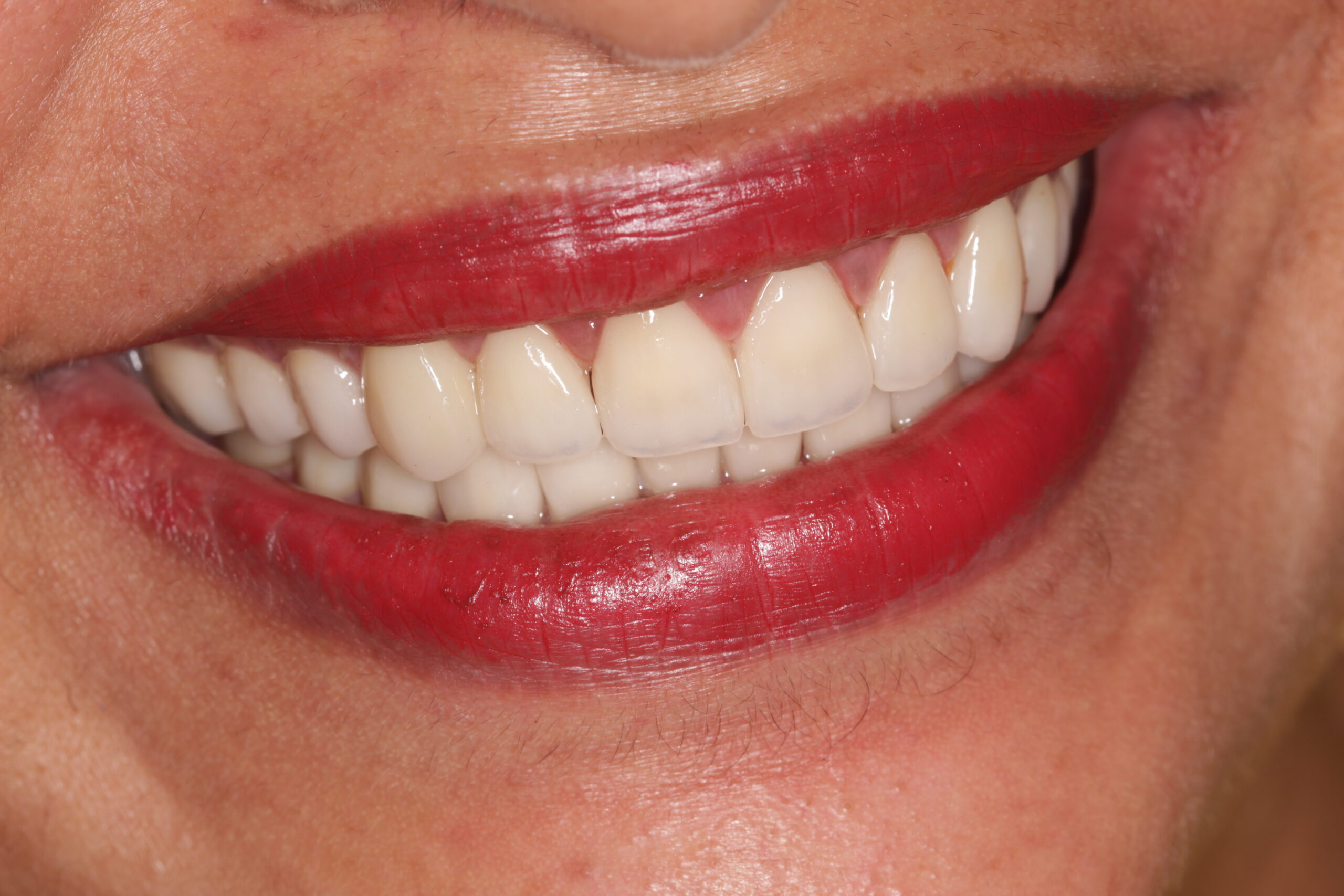 http://dentalexcellence.co.in/wp-content/uploads/2022/04/Pt-1-Post-2-2-scaled.jpg