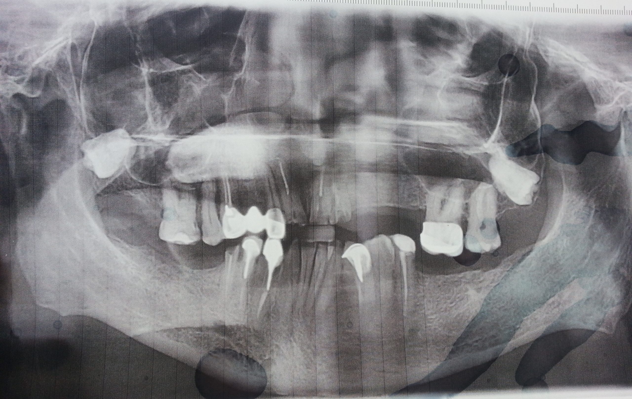 http://dentalexcellence.co.in/wp-content/uploads/2023/02/Pt-2-Pre-Implant-Xray-scaled.jpg