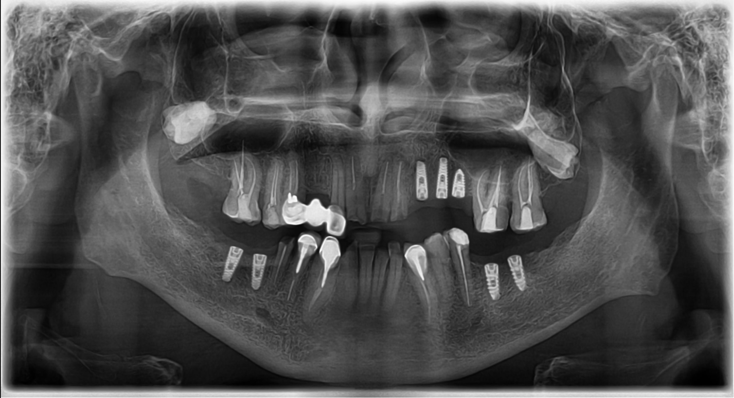 http://dentalexcellence.co.in/wp-content/uploads/2023/02/Pt-3-Post-Implant-Placement-1-scaled.jpg