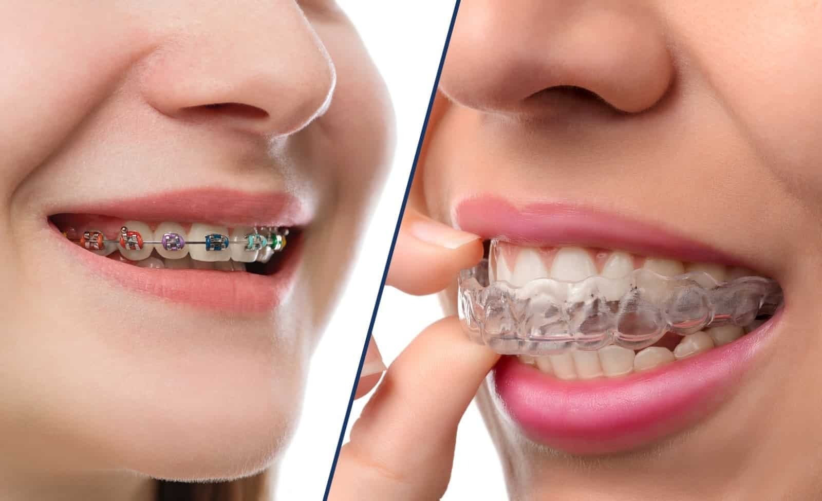 http://dentalexcellence.co.in/wp-content/uploads/2024/03/Invisalign-vs-Braces.jpg