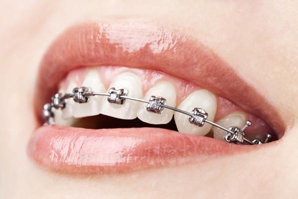 Orthodontic Treatment (Braces) in Mohali