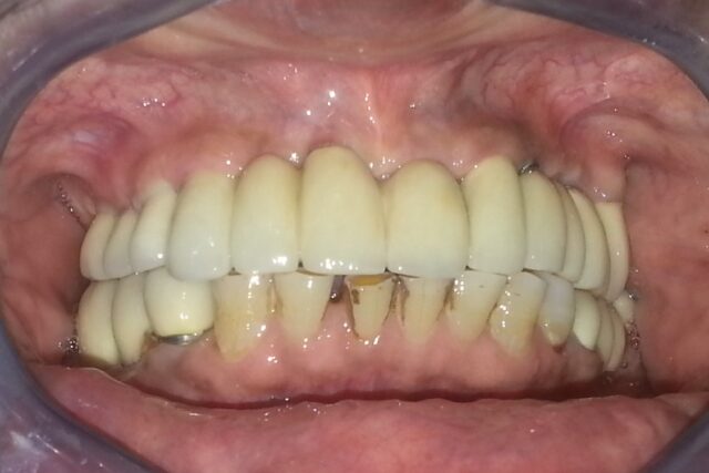 after -implant treatment 