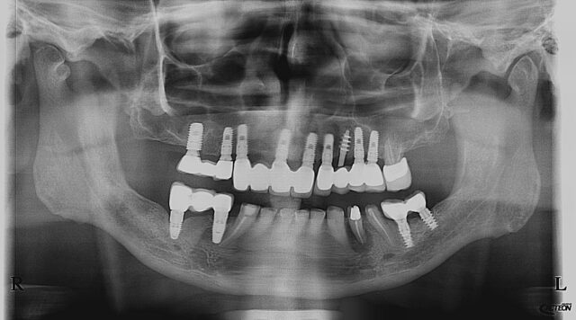 x ray with implants 