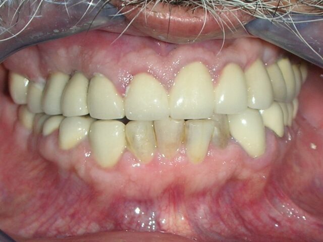 before implants 