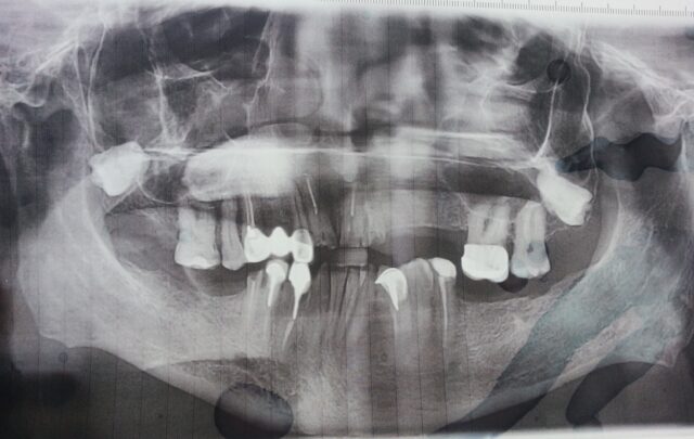 pre operative OPG 