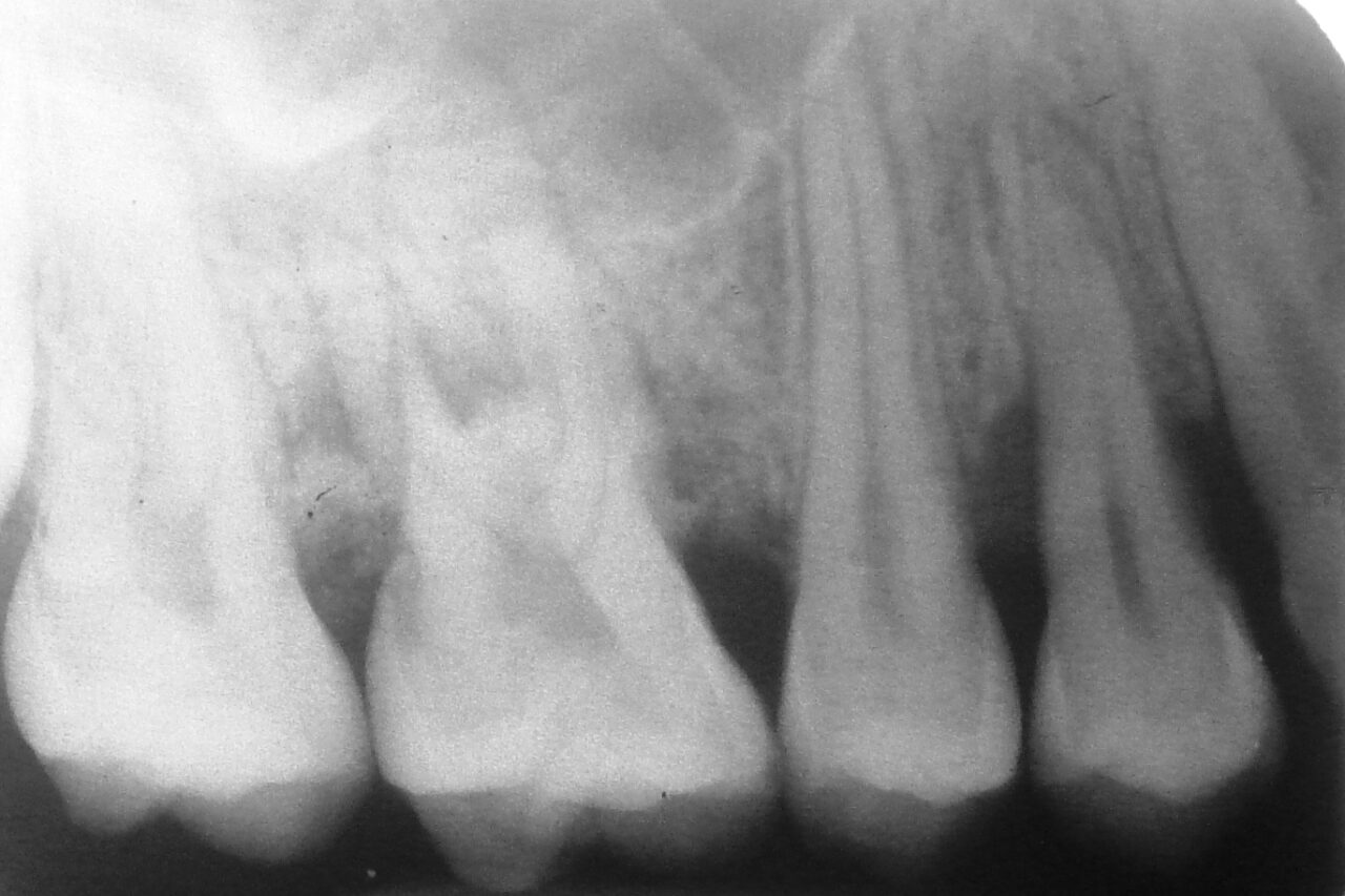 Gum Surgeries/ Bone Grafting Dental Excellence