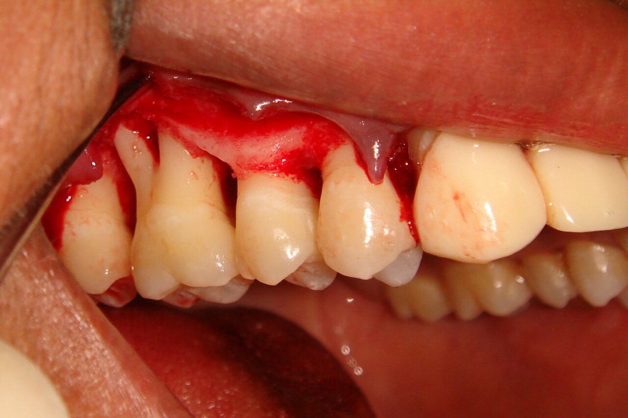 Gum Surgeries/ Bone Grafting Dental Excellence