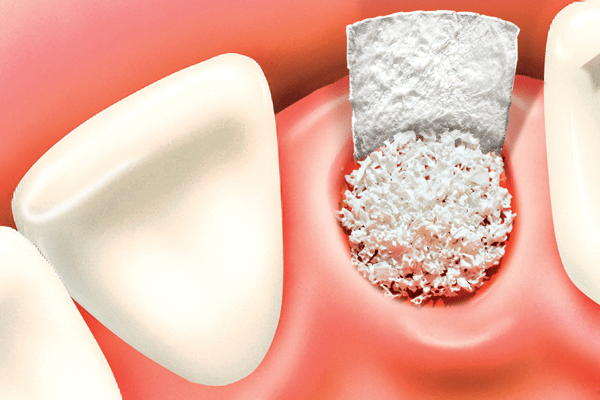 Gum Surgeries/ Bone Grafting