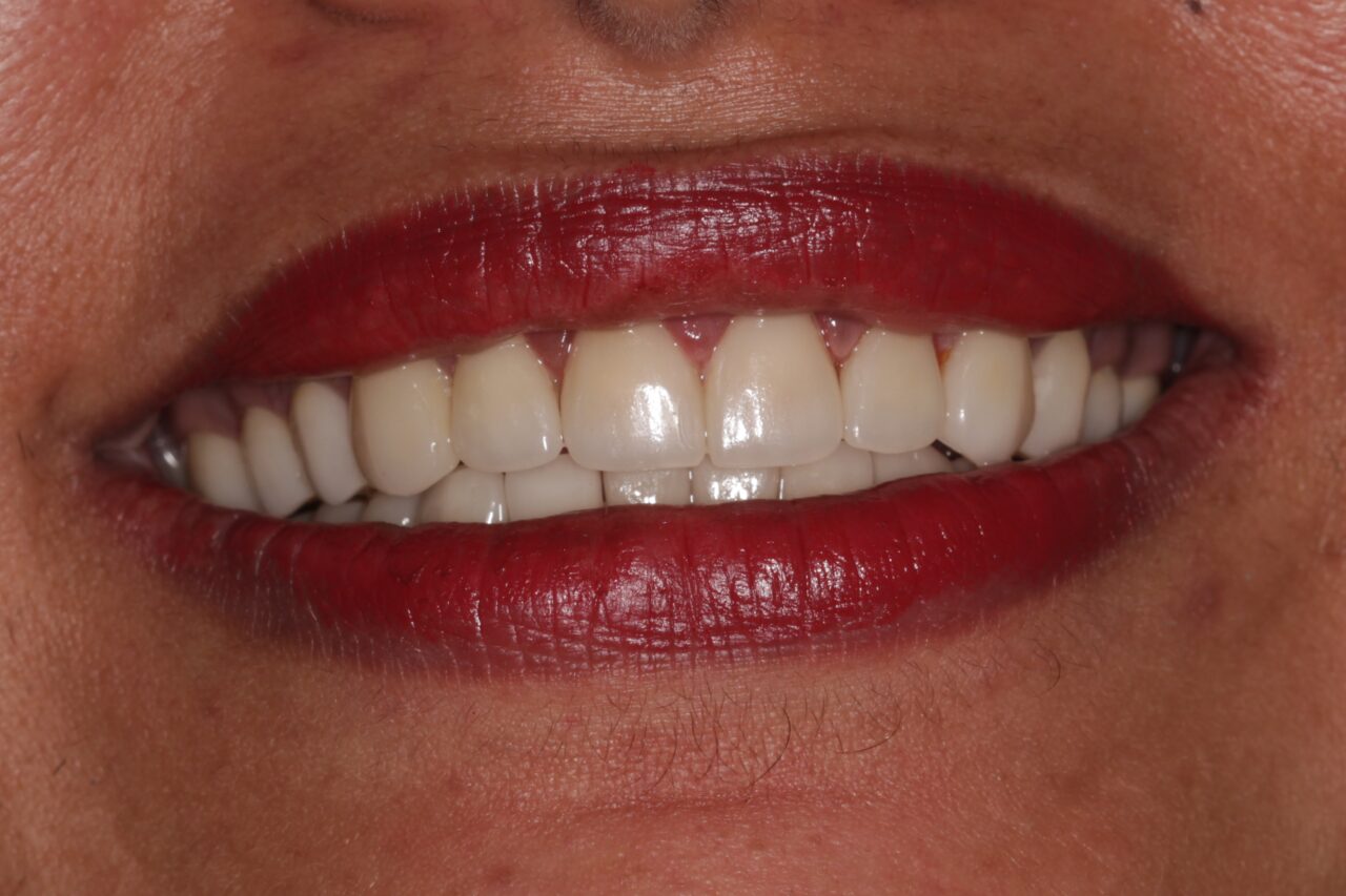 Smile Makeover (Veneers) Dental Excellence