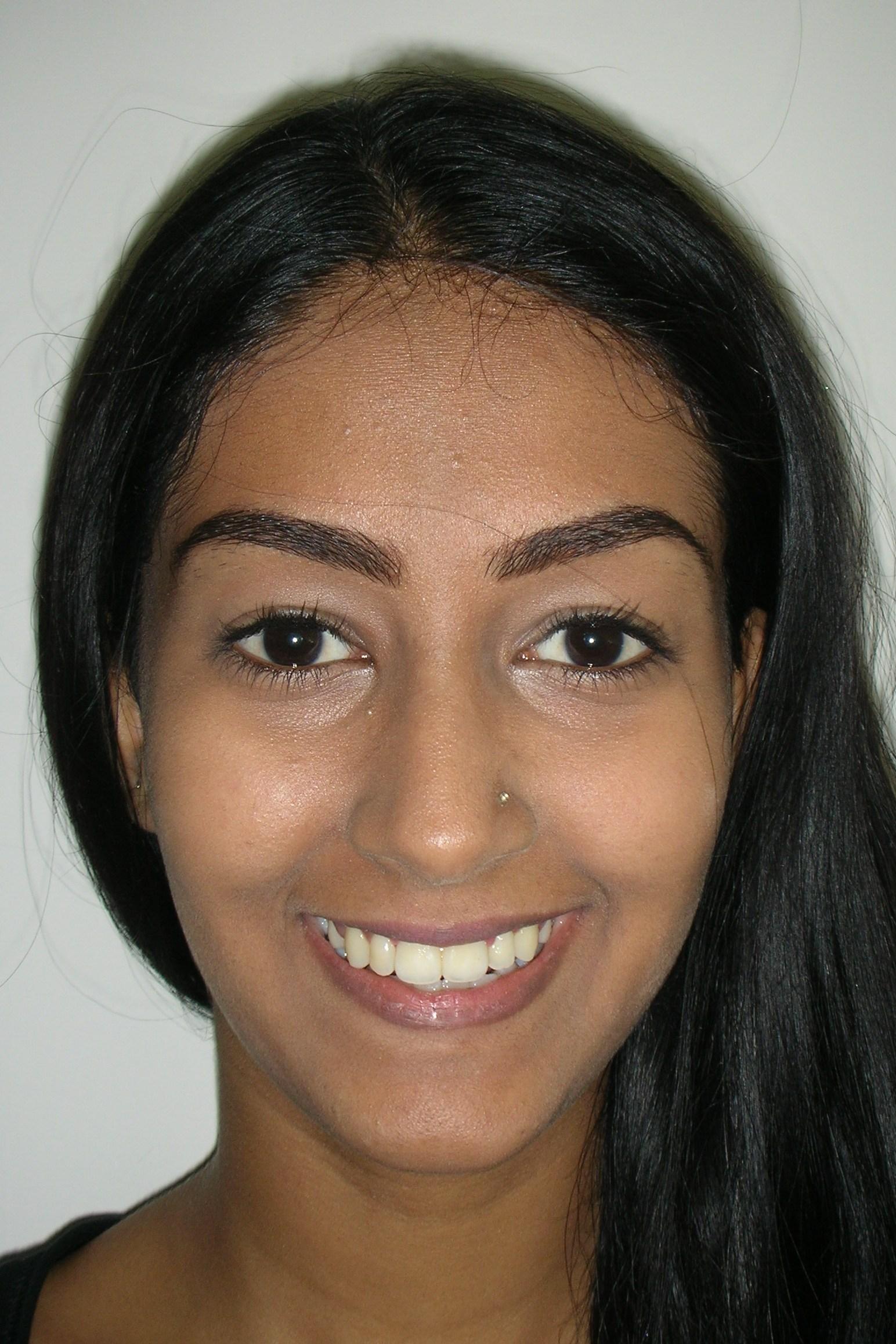 Transform Your Smile with Orthodontic Treatment (Braces) in Mohali