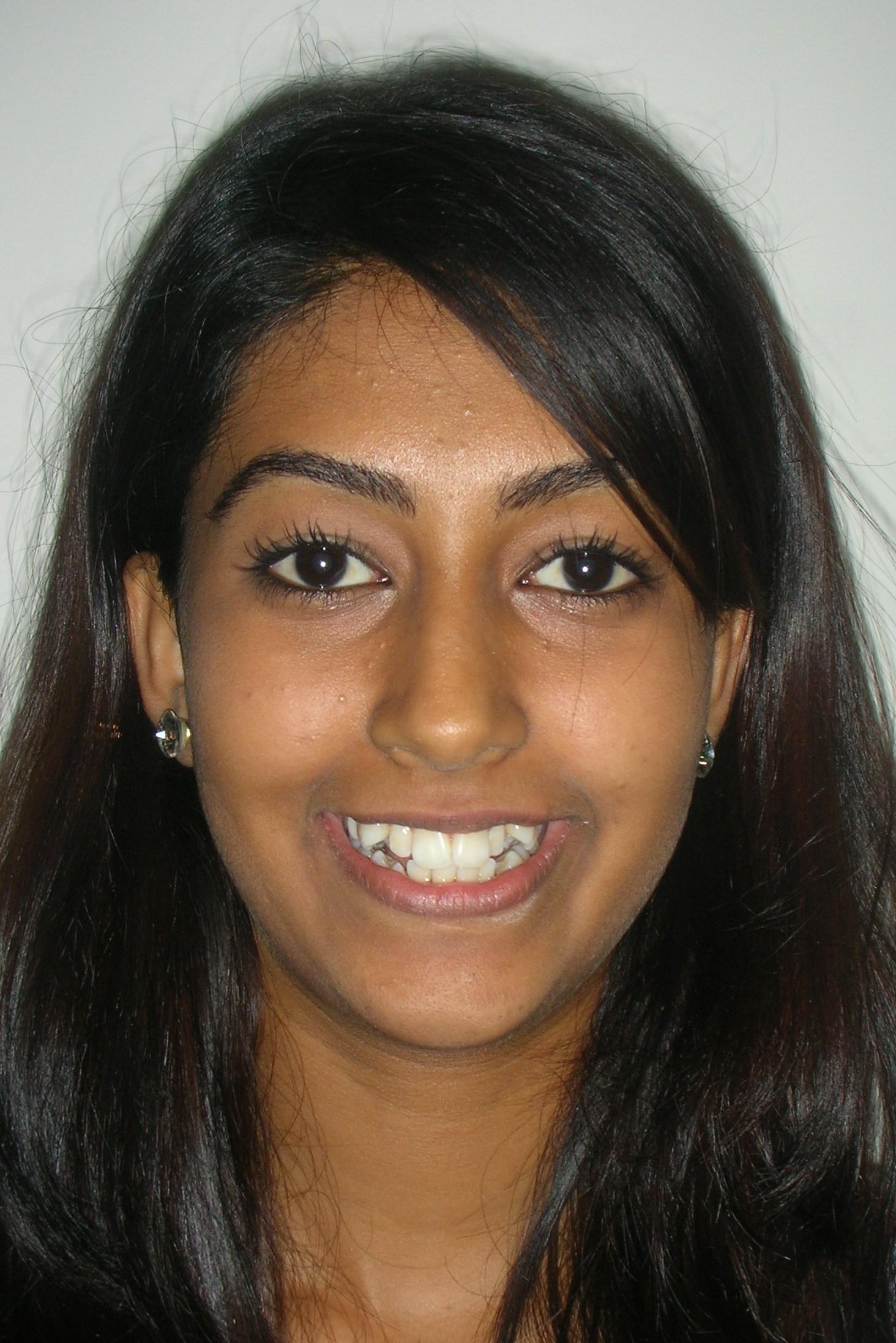 Transform Your Smile with Orthodontic Treatment (Braces) in Mohali