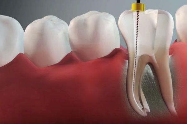 Painless Root Canal Treatment (RCT)