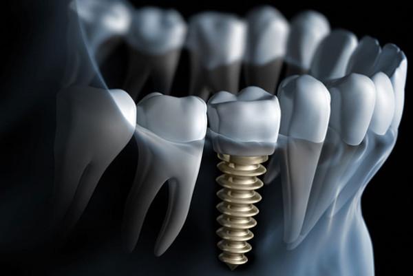 Graphical representation of a tooth after dental implant