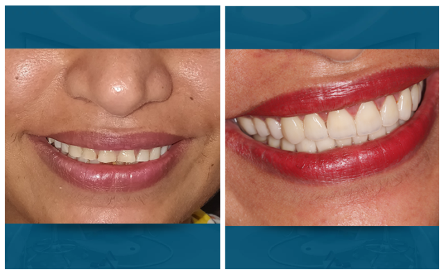full mouth rehabilitation with veneers