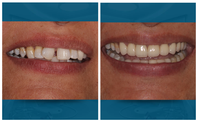 smile designing with E-max crowns